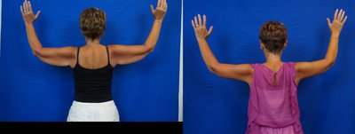 Arm Lift before and after photo