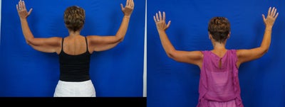 Arm Lift before and after photo