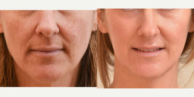 CO2 Laser before and after photo