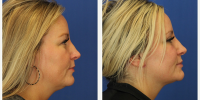 Eyelid Surgery before and after photo