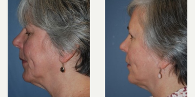 Facelift before and after photo