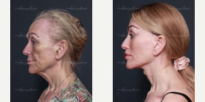 Facial Fat Transfer before and after photo