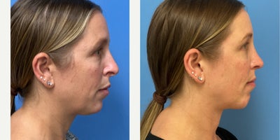 Rhinoplasty before and after photo