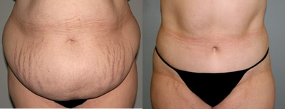 Tummy Tuck before and after photo