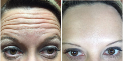 Botox before and after photo