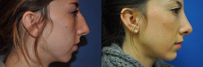 Chin Implant before and after photo