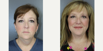 Facelift before and after photo