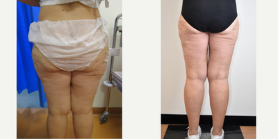 Liposuction before and after photo
