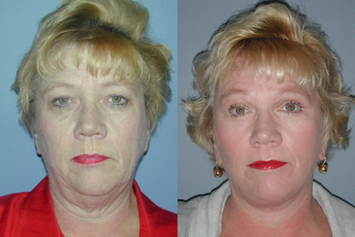 Mini Facelift before and after photo