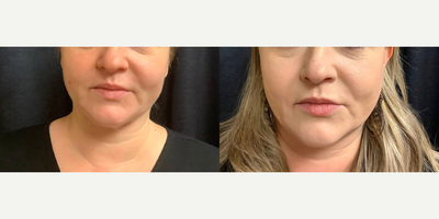 Nonsurgical Facelift before and after photo
