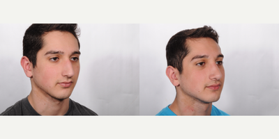 Rhinoplasty before and after photo