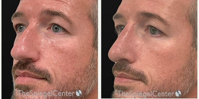 Rhinoplasty before and after photo