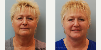 SAFELipo before and after photo