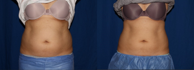 Vanquish before and after photo