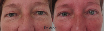 Eyelid Surgery before and after photo