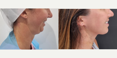 FaceTite before and after photo