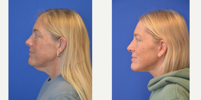 Neck Lift before and after photo