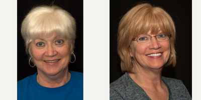All-on-4 Dental Implants before and after photo