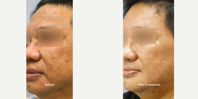 Botox before and after photo