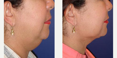 Chin Liposuction before and after photo