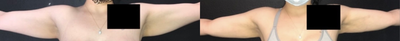 CoolSculpting before and after photo