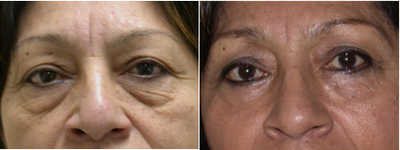 Eyelid Surgery before and after photo