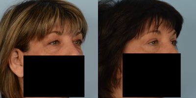 Eyelid Surgery before and after photo