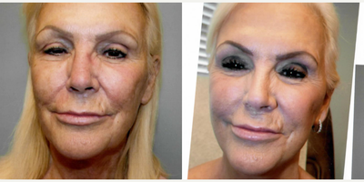 Facelift before and after photo