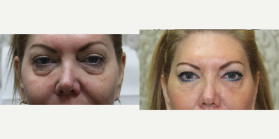 Belotero before and after photo