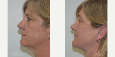 Facelift before and after photo