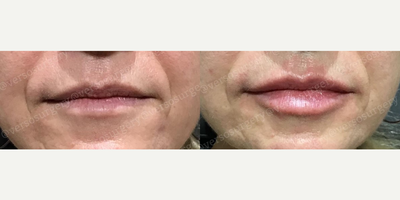 Lip Fillers before and after photo