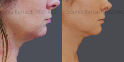 Neck Lift before and after photo