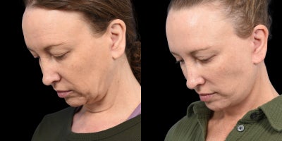 Deep Plane Facelift before and after photo