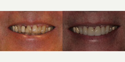 Dental Crown before and after photo