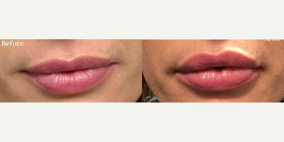 Lip Fillers before and after photo