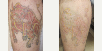 Tattoo Removal before and after photo