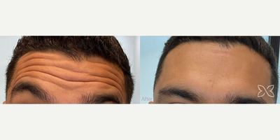 Botox before and after photo