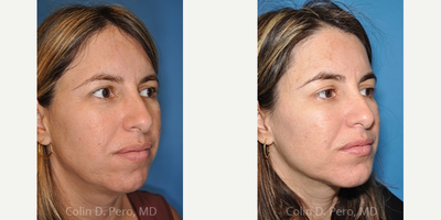 Chin Implant before and after photo