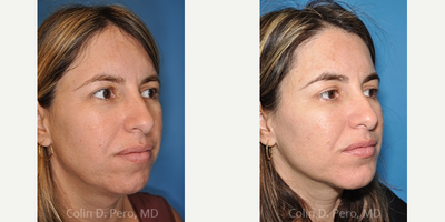 Chin Implant before and after photo