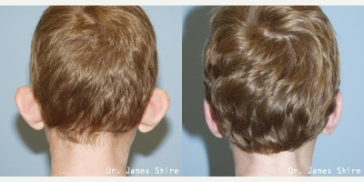 Earlobe Repair before and after photo