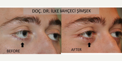 Eyelid Retraction Repair before and after photo