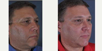Eyelid Surgery before and after photo