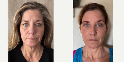 Facelift before and after photo