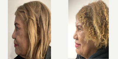 Lip Fillers before and after photo