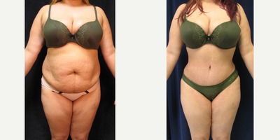 Tummy Tuck before and after photo