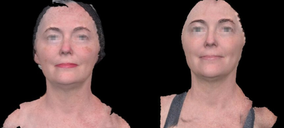 Halo Laser before and after photo