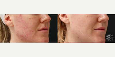 IPL before and after photo