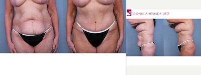 Tummy Tuck before and after photo
