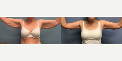 Arm Lift before and after photo