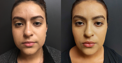 Buccal Fat Removal before and after photo